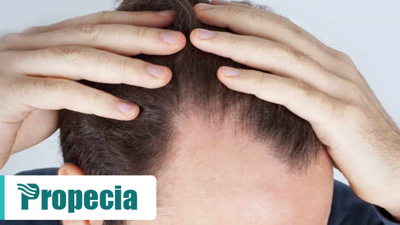 Alopecia