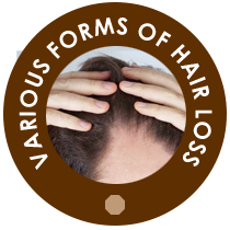 Various Forms of Hair Loss