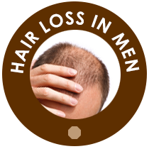 Hair Loss in Men