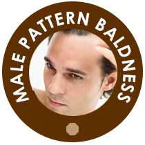 Male Pattern Baldness