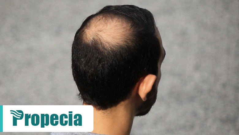 Prevent Hair Loss